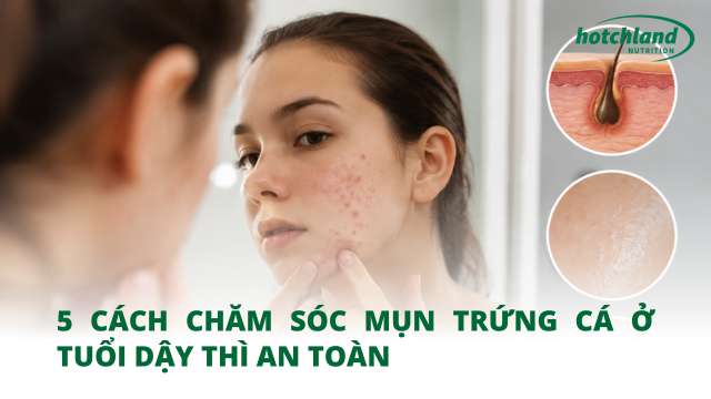 5 cách chăm sóc mụn trứng cá ở tuổi dậy thì an toàn