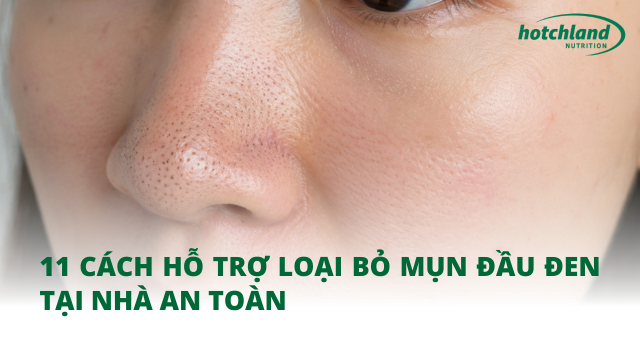 11 cách hỗ trợ loại bỏ mụn đầu đen tại nhà an toàn