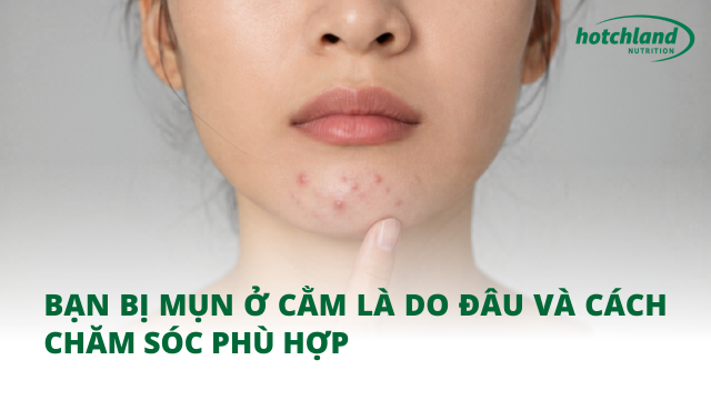 Bạn bị mụn ở cằm là do đâu và cách chăm sóc phù hợp