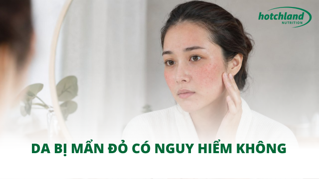 Da bị mẩn đỏ có nguy hiểm không