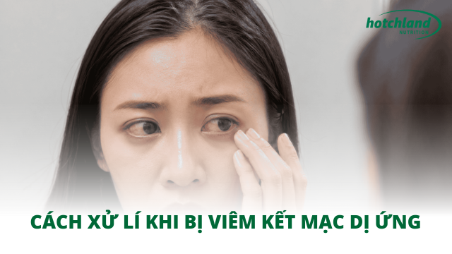 Cách xử lí khi bị viêm kết mạc dị ứng