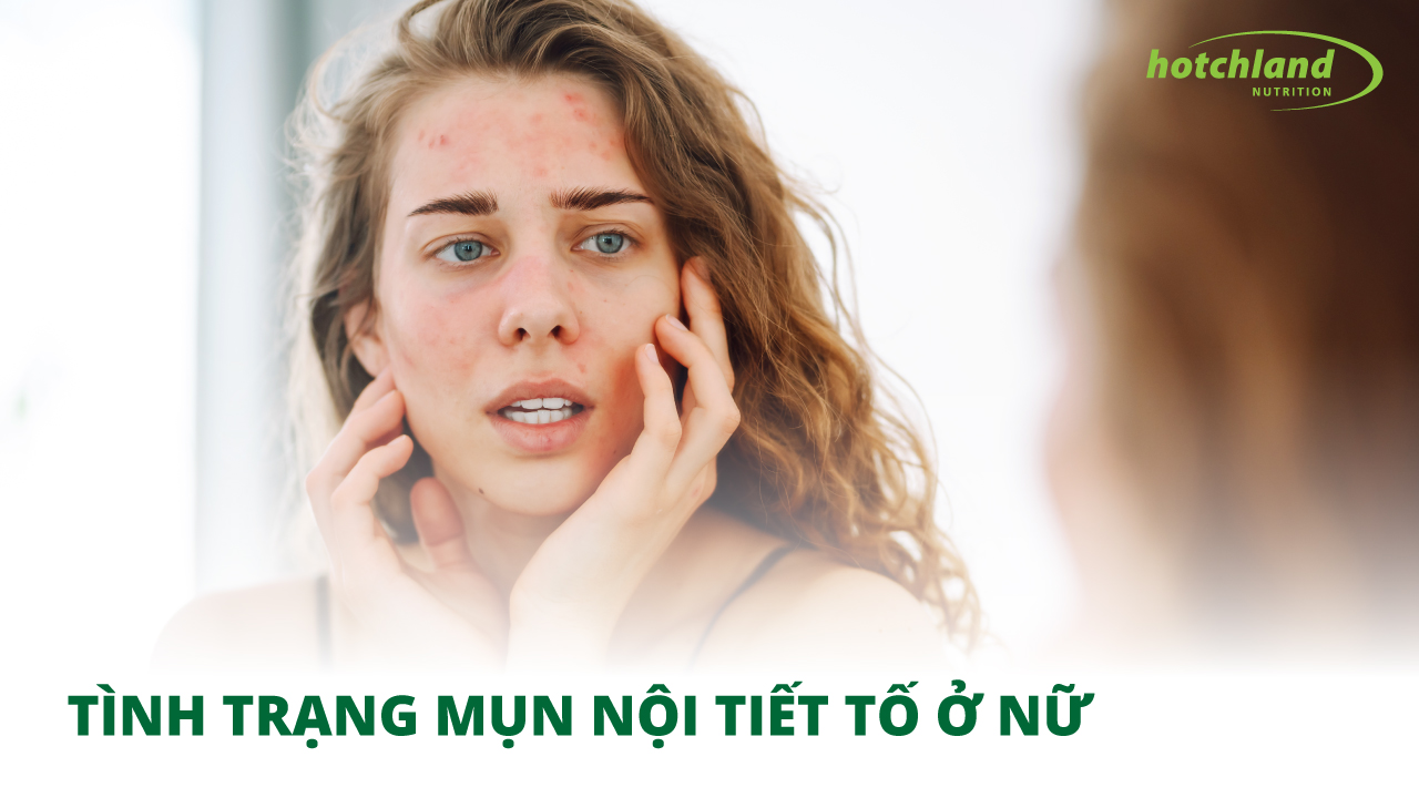 TÌNH TRẠNG MỤN NỘI TIẾT TỐ Ở NỮ | NGUYÊN NHÂN VÀ CÁCH KHẮC PHỤC