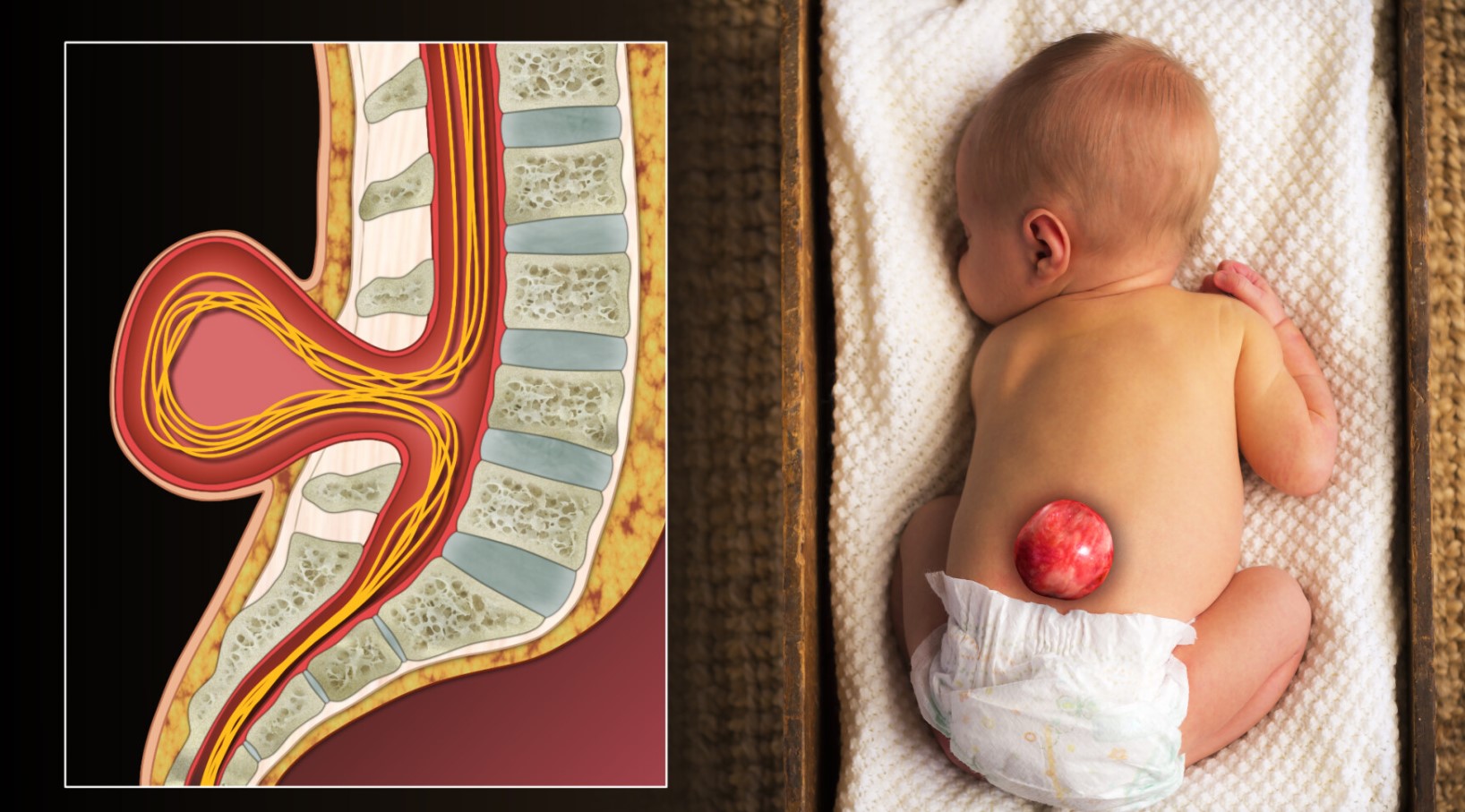 Dị tật nứt đốt sống