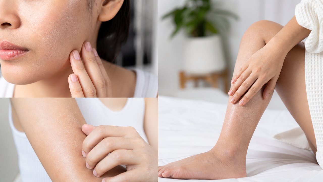 Da khô xảy ra ở nhiều vùng khác nhau trên cơ thể