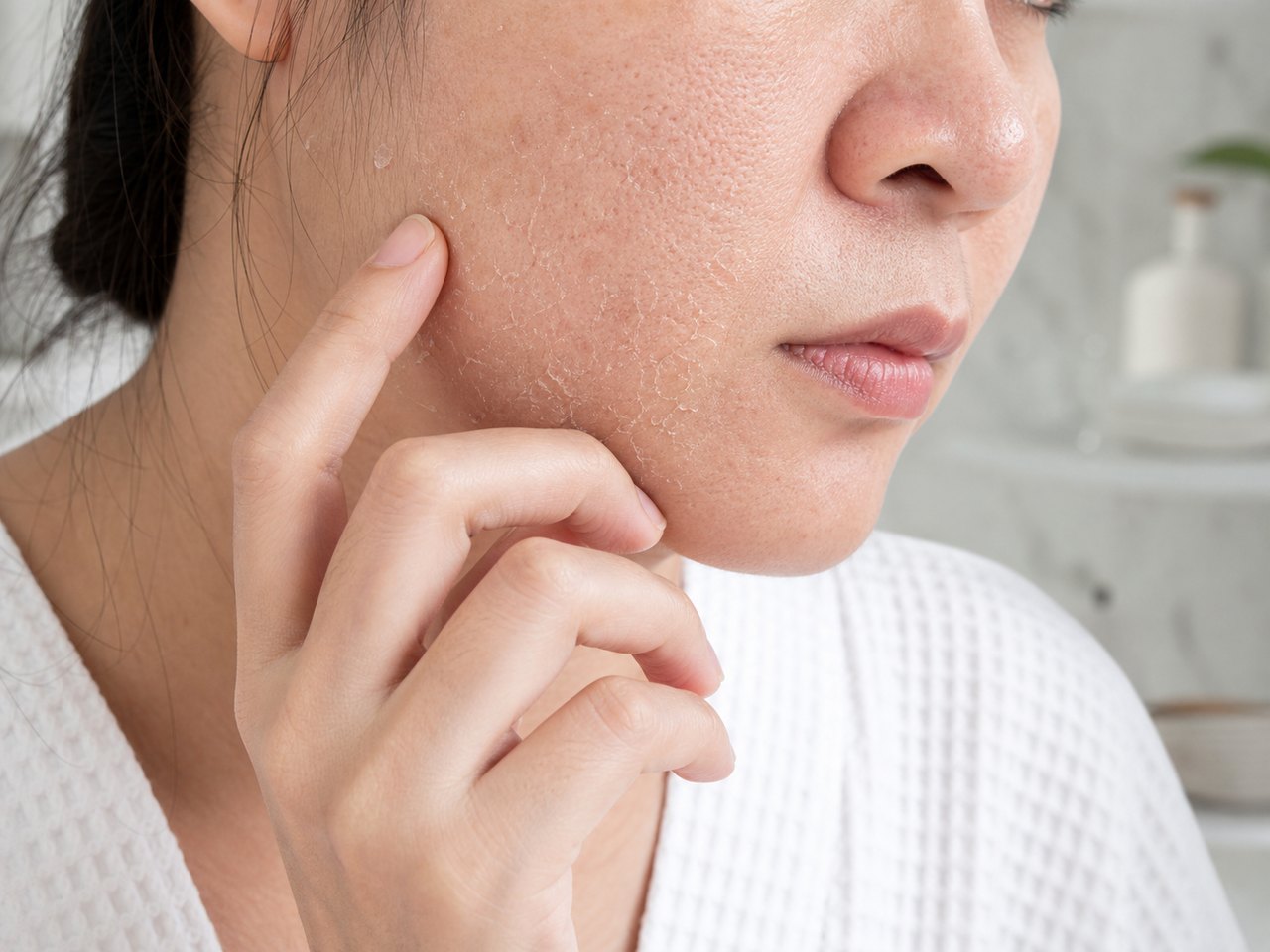 Da khô tróc vảy có thể là dấu hiệu hàng rào bảo vệ da đang suy yếu