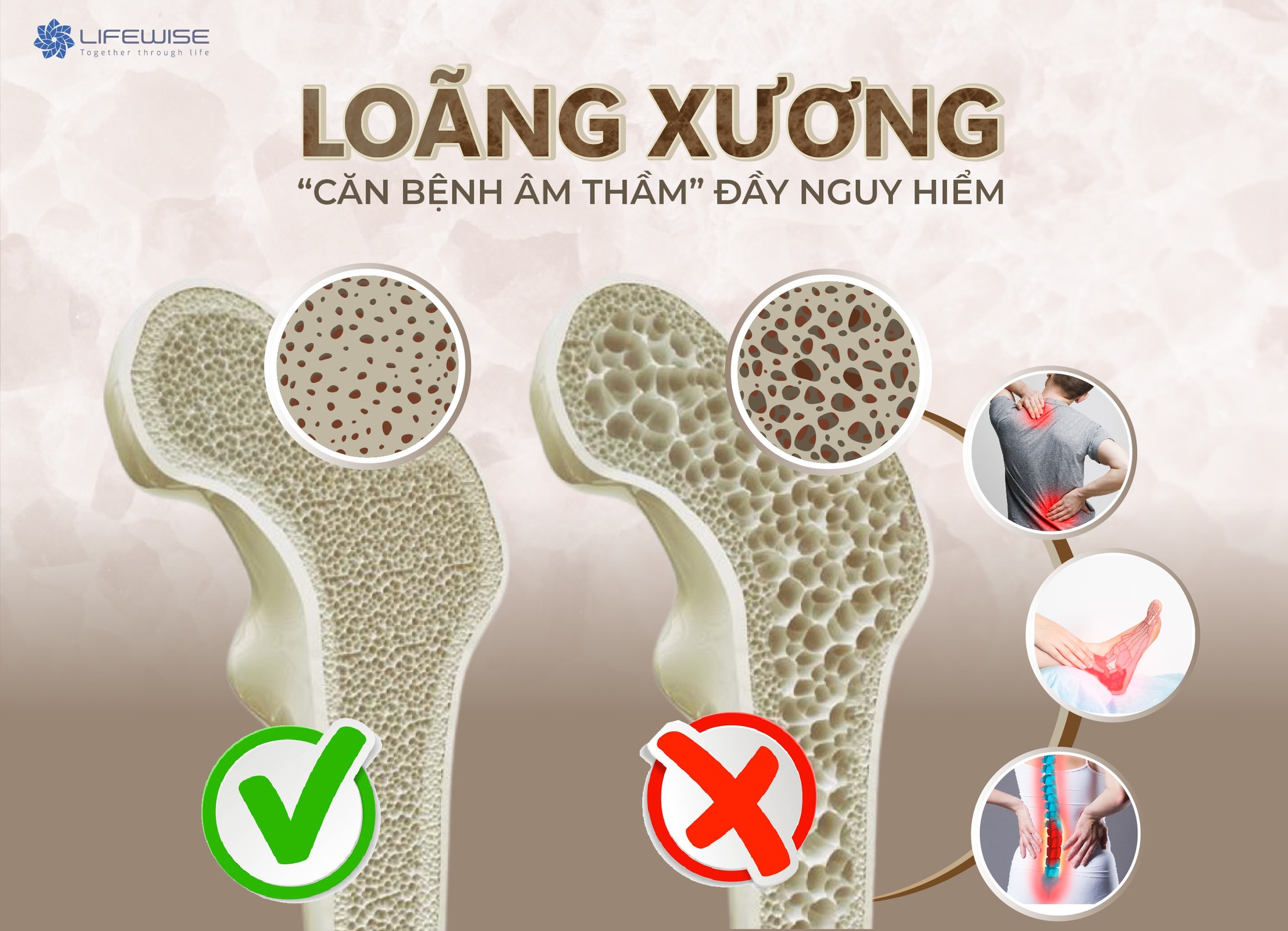 LOÃNG XƯƠNG - 