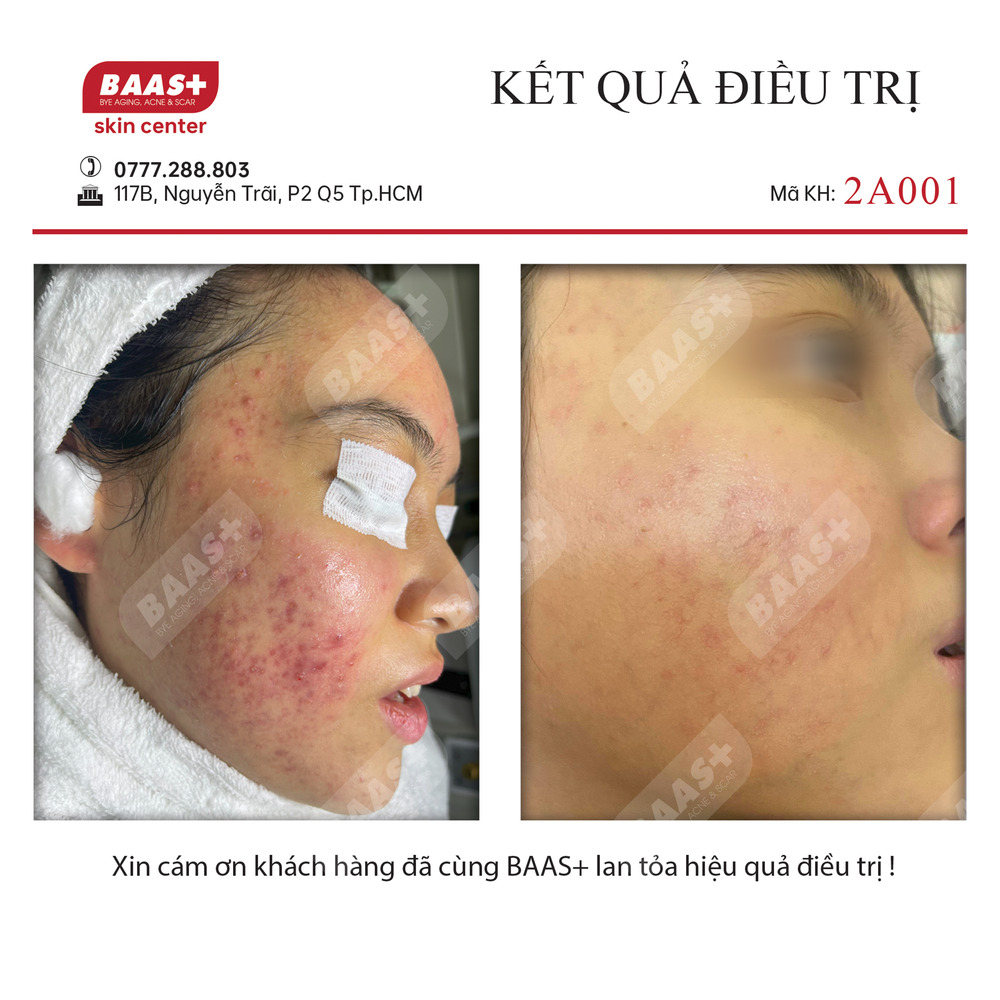 2A001 Kết quả điều trị Mụn tại BAAS Plus
