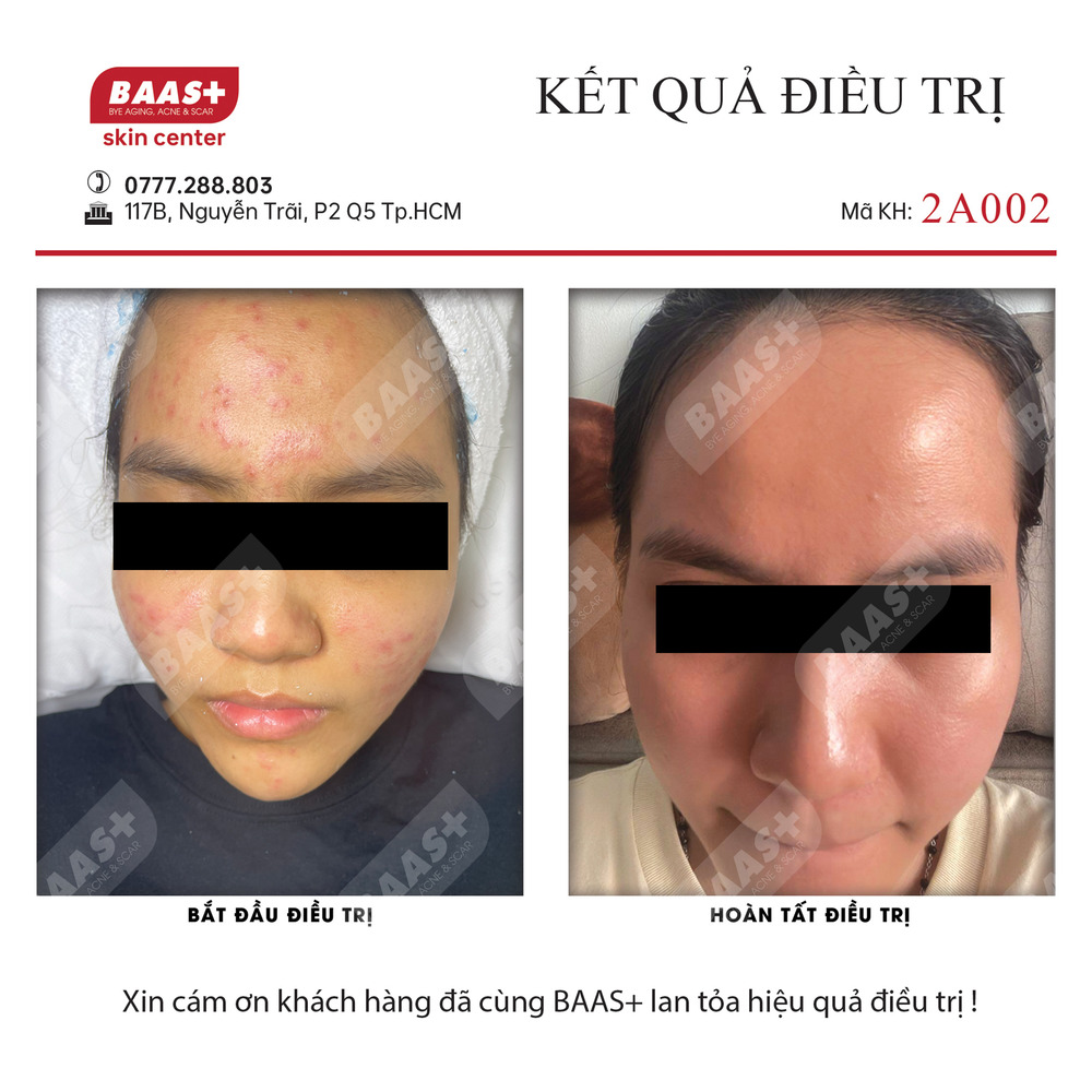 2A002 - Kết quả điều trị mụn tại BAAS Plus
