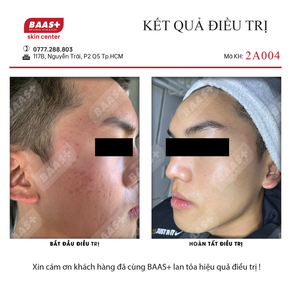 2A004 - Kết quả điều trị mụn tại BAAS Plus