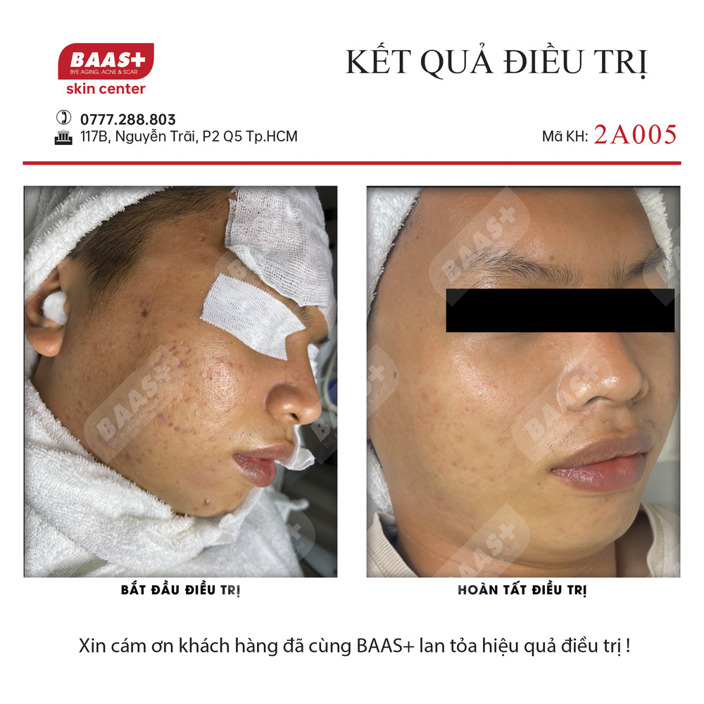 2A005 - Kết quả điều trị mụn tại BAAS Plus