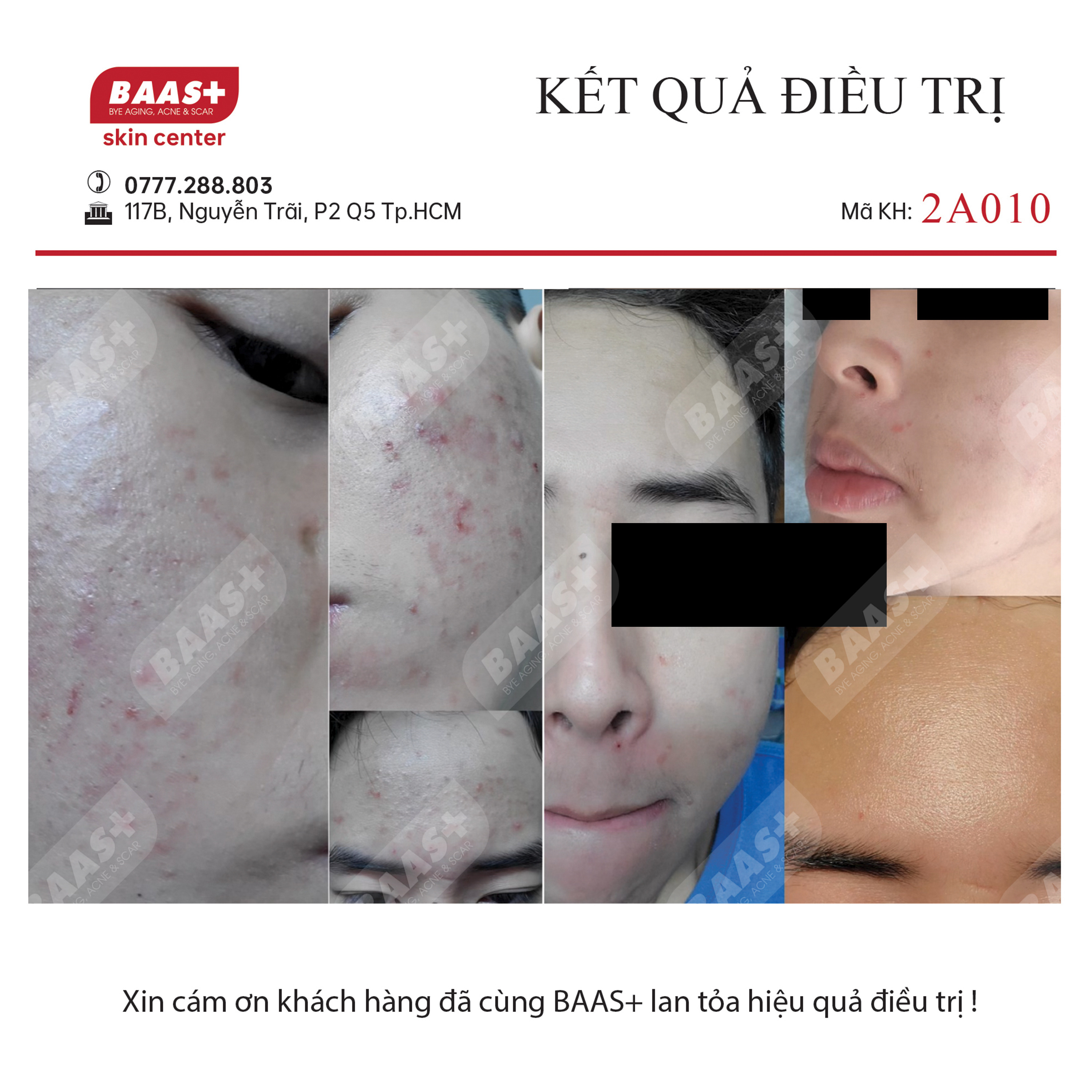 2A010 - Kết quả điều trị mụn tại BAAS Plus