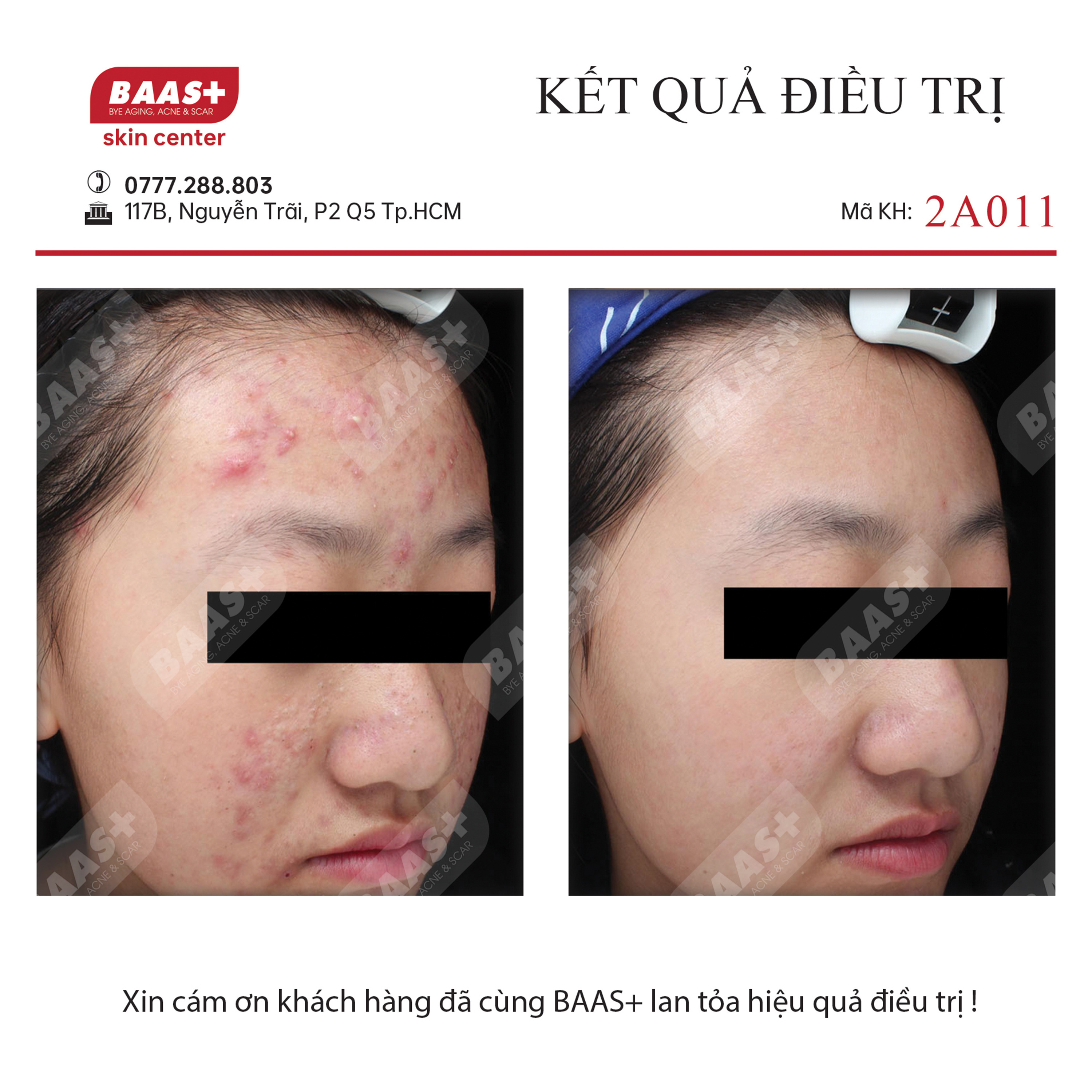 2A011 - Kết quả điều trị mụn tại BAAS Plus