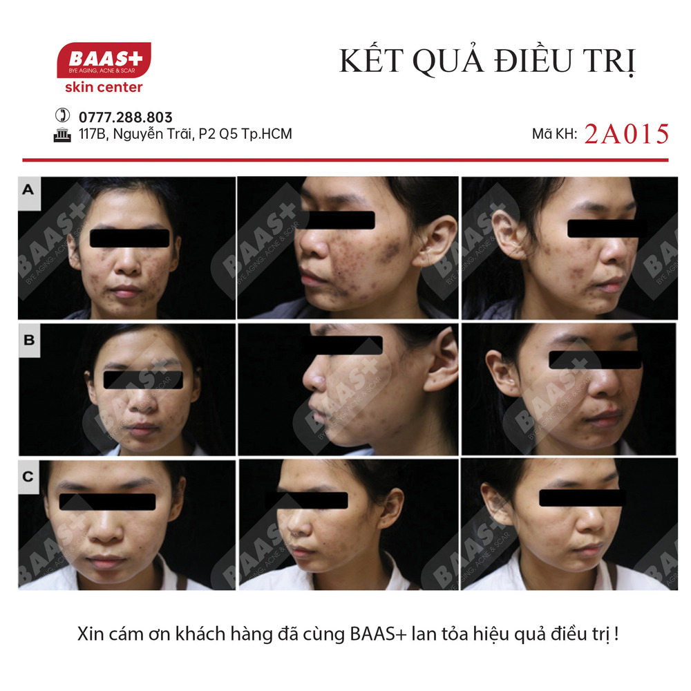 2A015 - Kết quả điều trị mụn tại BAAS Plus