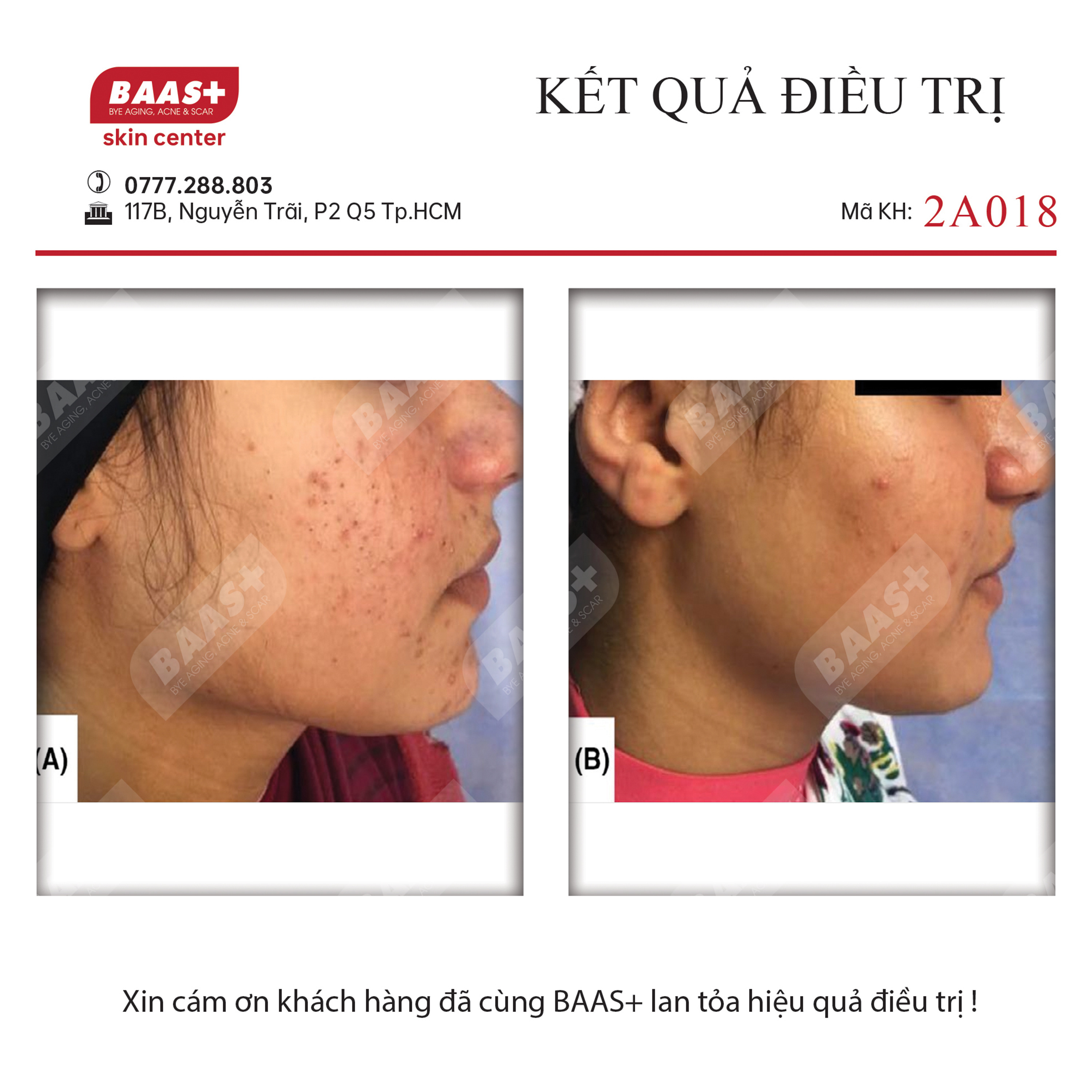 2A018 - Kết quả điều trị mụn tại BAAS Plus