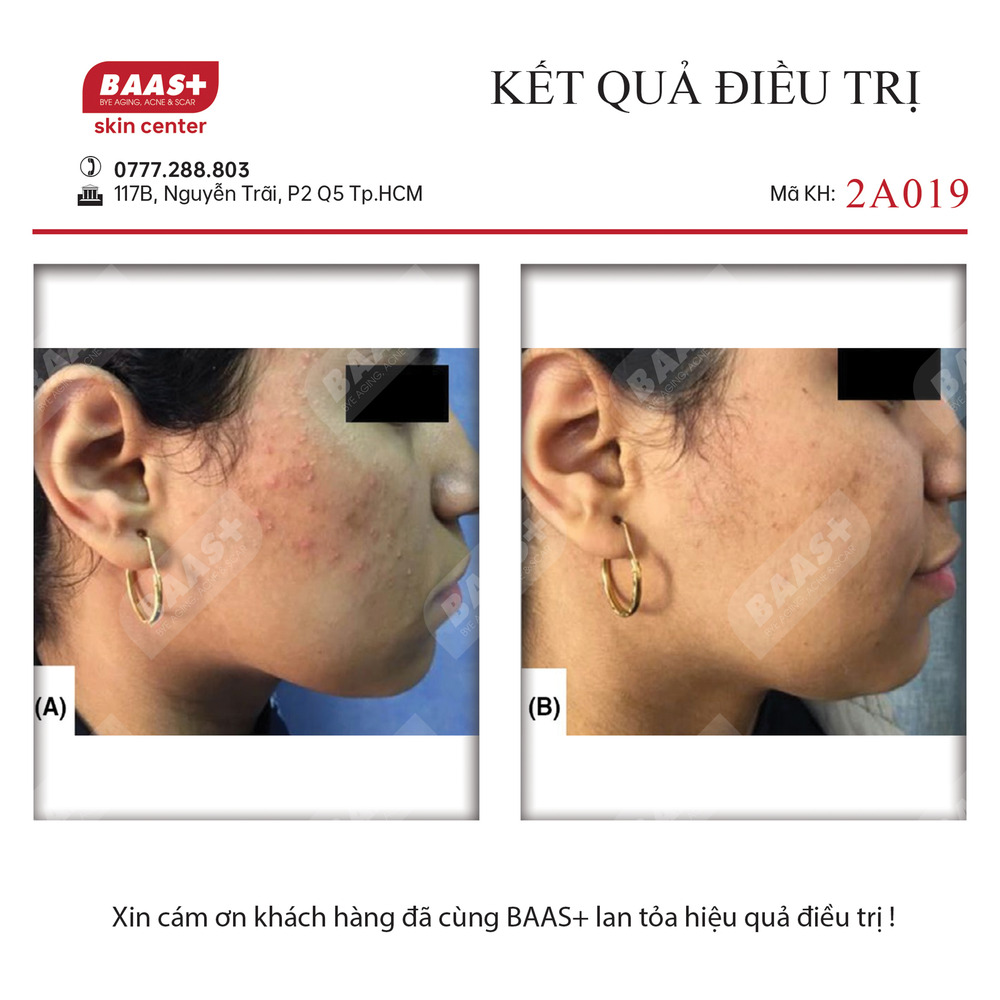 2A019 - Kết quả điều trị mụn tại BAAS Plus