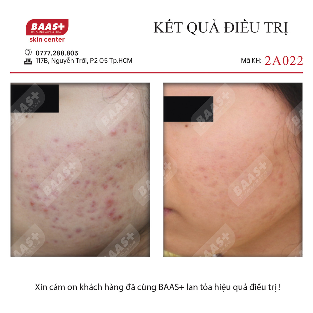 2A022 - Kết quả điều trị 