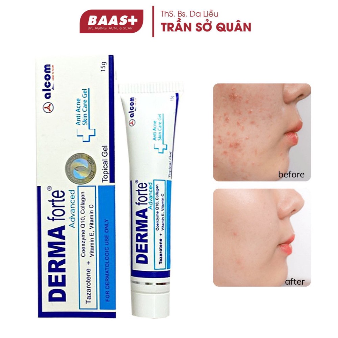 GEL Hỗ Trợ Làm Mờ Sẹo, Ngừa Thâm, Ngừa Tái Phát Mụn, Sạch Bã Nhờn (Bản Nâng Cấp) - DERMA-FORTE ADVANCED (15g)