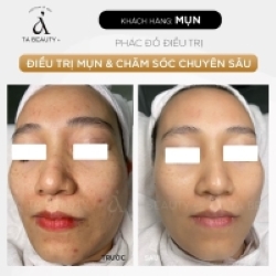 Điều trị mụn