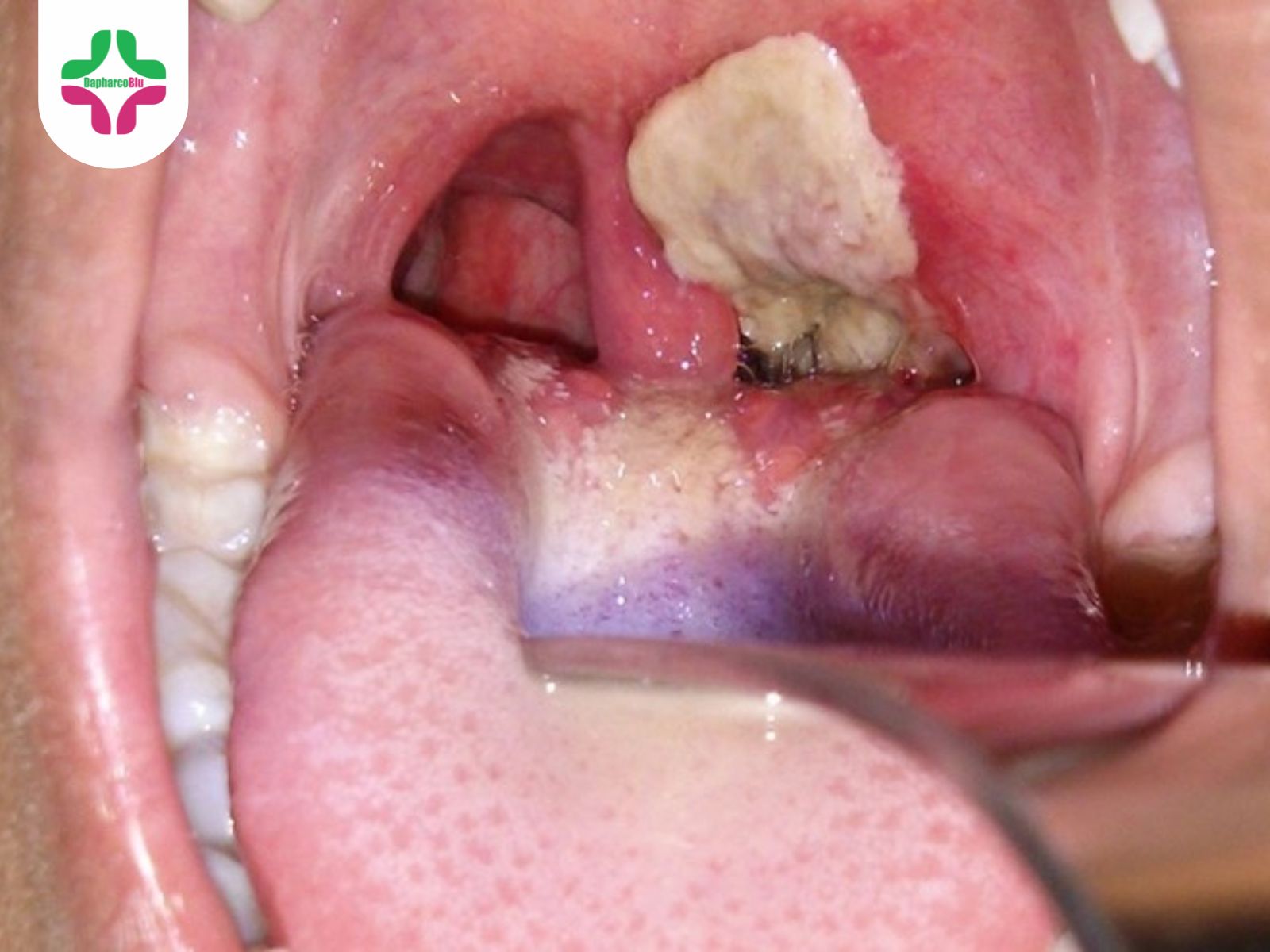 Biện Pháp Phòng Ngừa Bệnh Bạch Hầu