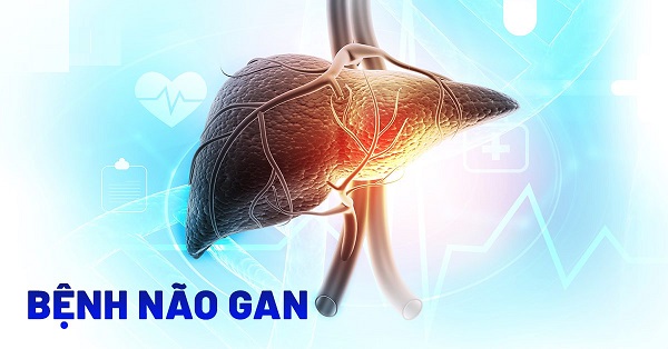 Bệnh não gan (hôn mê gan): Nguyên nhân, triệu chứng, chẩn đoán và điều trị