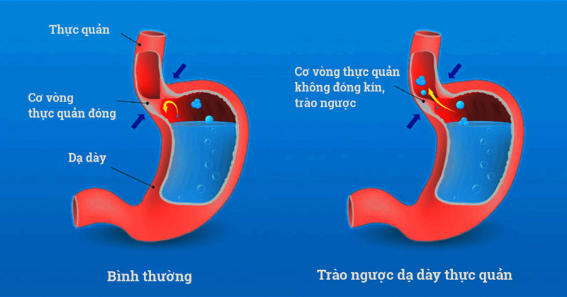 Bệnh trào ngược dạ dày - thực quản, triệu chứng và cách điều trị