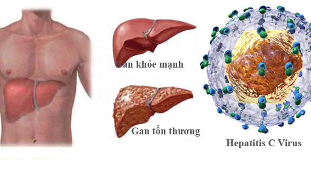 Bệnh Viêm Gan C Là Gì? Thuốc Điều Trị Viêm Gan C