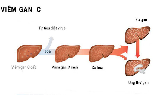 Viêm gan C – Đừng chủ quan