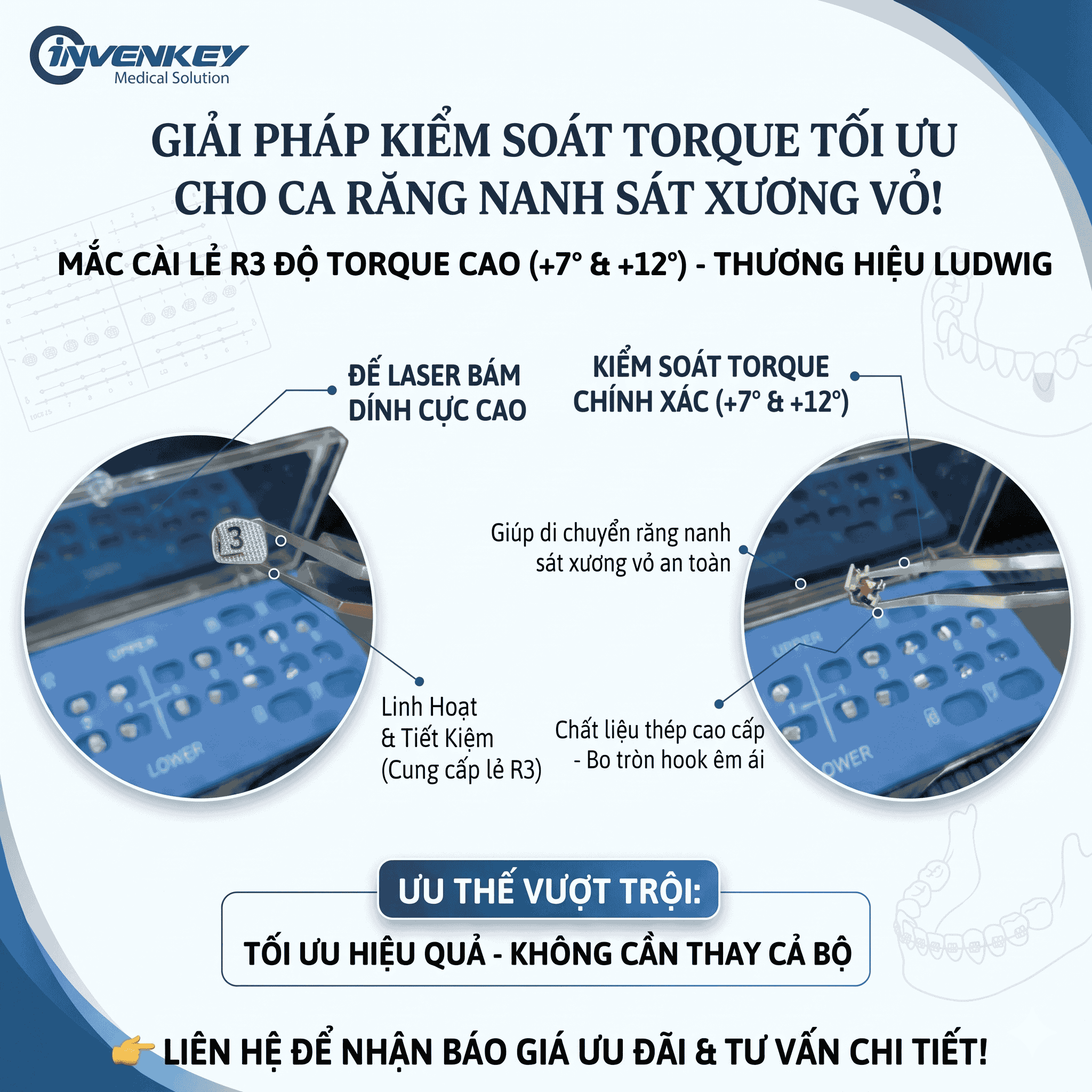 Mắc cài răng 3 torque +7 Ludwig