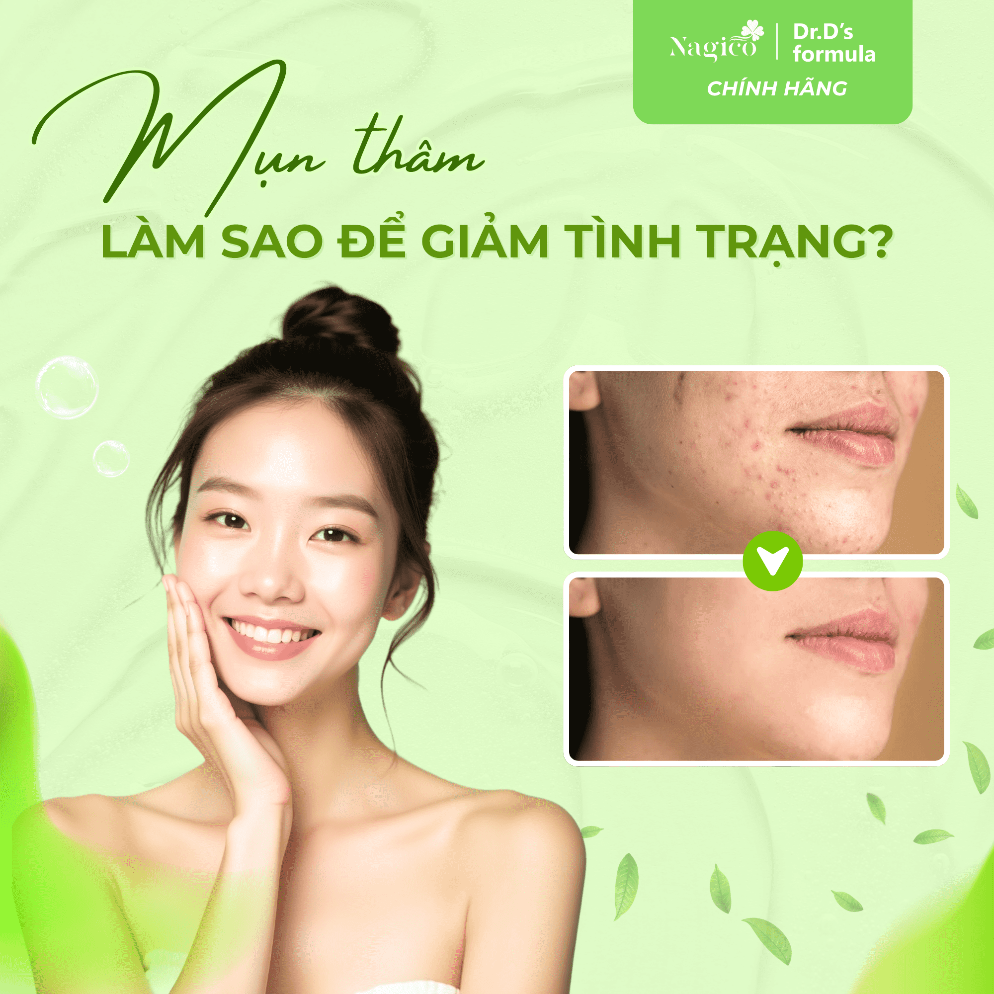 TẠM BIỆT DA MỤN - TÌM BÍ QUYẾT CÙNG NAGICO