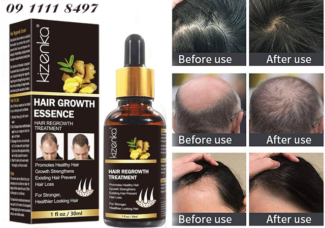 công dụng kizenka hair growth essence 
