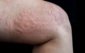 GIÚP VIỆC GIA ĐÌNH - CÁC MẸO TRỊ PHÁT BAN DO THỜI TIẾT