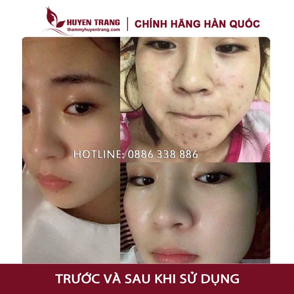 Hộp 20 Lọ Tế Bào Gốc CUTISCURA Serum Mụn, Trắng Da, Mờ Nám, Tàn Nhang, Nâng Cơ trẻ Hóa Tái Tạo Da Sẹo Rỗ NANOCEE