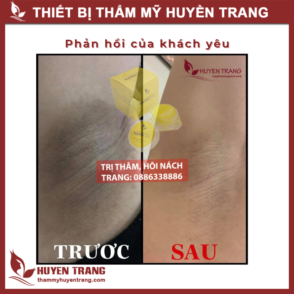 Kem Khử Mùi Hôi Nách, Khử Thâm Nách, Làm Trắng Nách NANOCEE [Che tên sản phẩm]