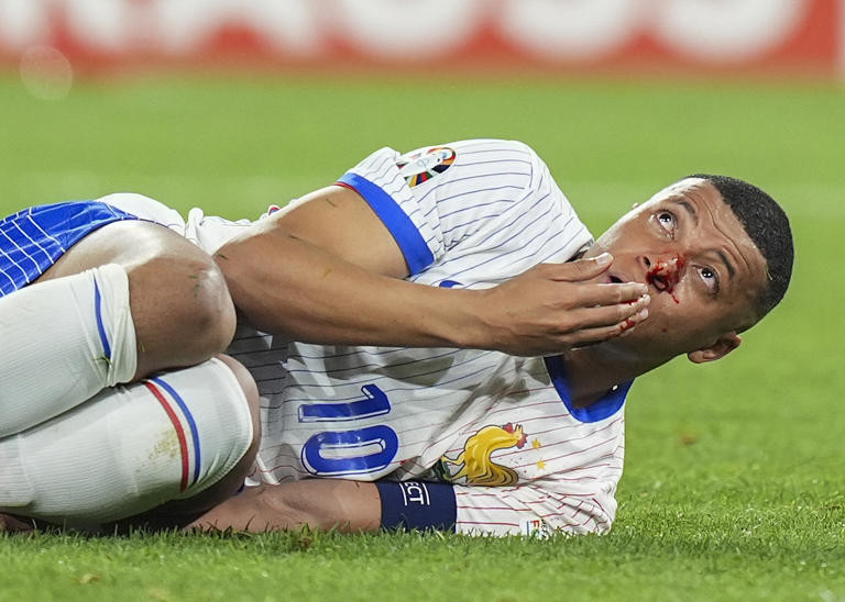 Làm gì khi bị vỡ mũi như Mbappe?