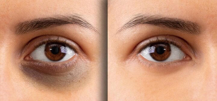 Cách khắc phục quầng thâm dưới mắt