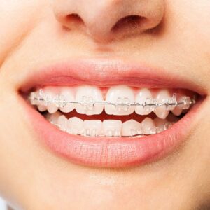 Niềng răng thẩm mỹ