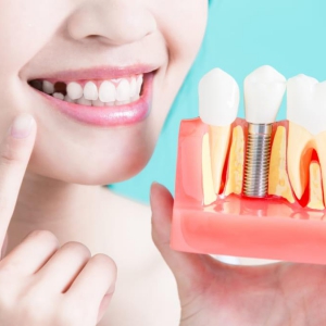 Trồng răng Implant
