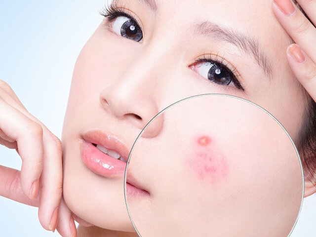 8 bước chăm sóc da dầu mụn nhanh chóng phục hồi