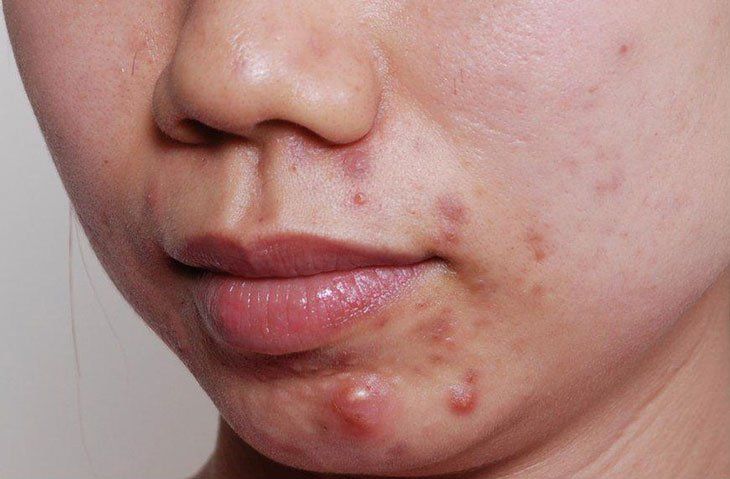 Mọc mụn ở cằm có phải do rối loạn nội tiết?