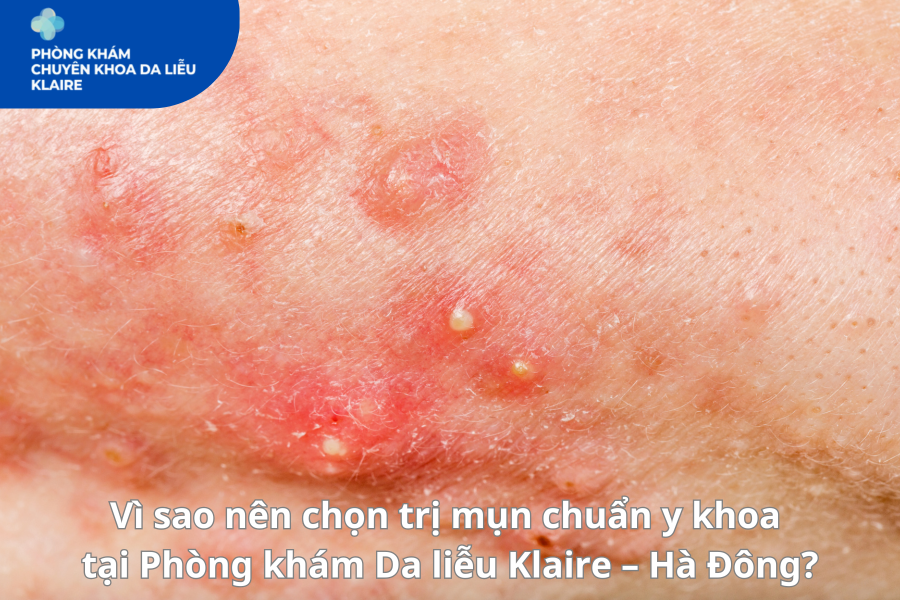 Hà Đông trị mụn ở đâu? Giải pháp trị mụn chuẩn y khoa tại Phòng khám Da liễu Klaire