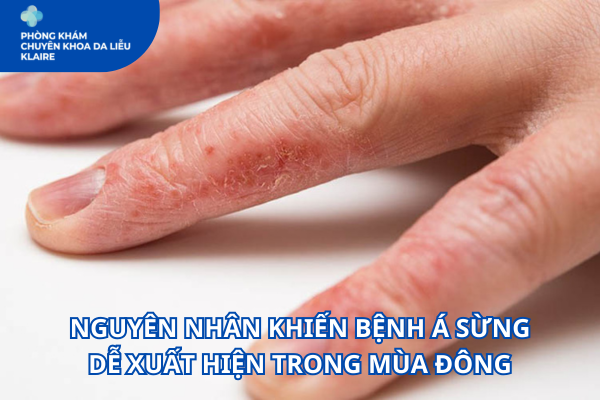 NGUYÊN NHÂN KHIẾN BỆNH Á SỪNG DỄ XUẤT HIỆN TRONG MÙA ĐÔNG