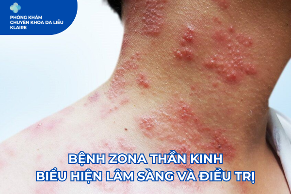 BỆNH ZONA THẦN KINH: BIỂU HIỆN LÂM SÀNG VÀ ĐIỀU TRỊ