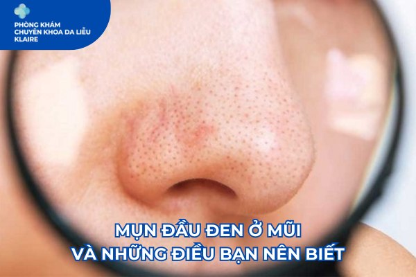 MỤN ĐẦU ĐEN Ở MŨI VÀ NHỮNG ĐIỀU BẠN NÊN BIẾT