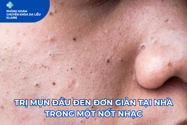 TRỊ MỤN ĐẦU ĐEN ĐƠN GIẢN TẠI NHÀ TRONG MỘT NỐT NHẠC