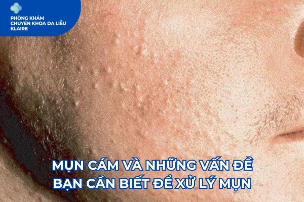 MỤN CÁM VÀ NHỮNG VẤN ĐỀ BẠN CẦN BIẾT ĐỂ XỬ LÝ MỤN