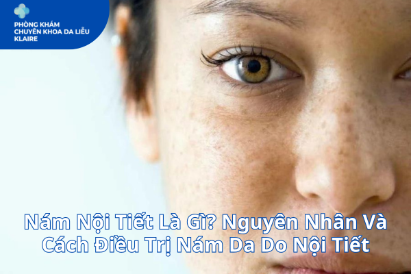 Nám Nội Tiết Là Gì? Nguyên Nhân Và Cách Điều Trị Nám Da Do Nội Tiết