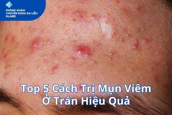 Top 5 Cách Trị Mụn Viêm Ở Trán Hiệu Quả