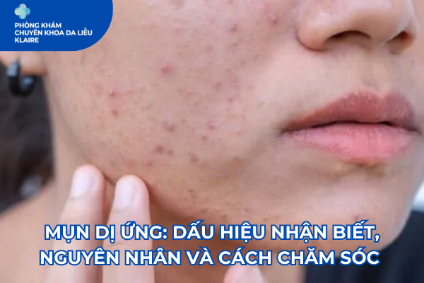 MỤN DỊ ỨNG: DẤU HIỆU NHẬN BIẾT, NGUYÊN NHÂN VÀ CÁCH CHĂM SÓC