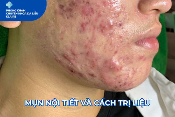 MỤN NỘI TIẾT VÀ CÁCH TRỊ LIỆU