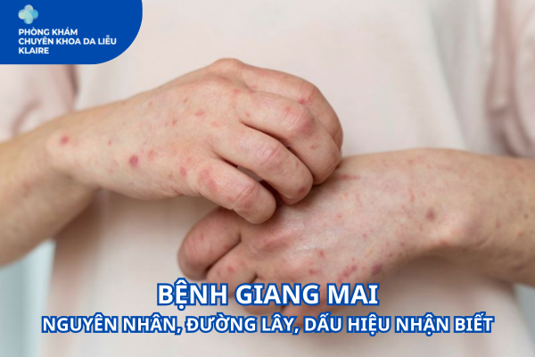 BỆNH GIANG MAI | NGUYÊN NHÂN, ĐƯỜNG LÂY, DẤU HIỆU NHẬN BIẾT